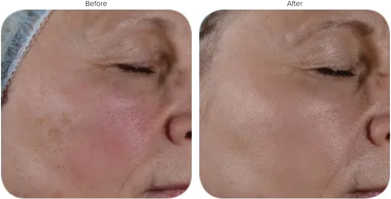 Fractional Skin Resurfacing before and after