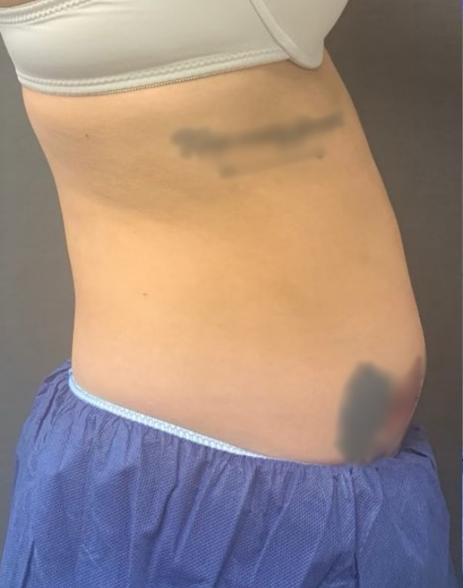 Coolsculpting