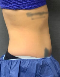 Coolsculpting