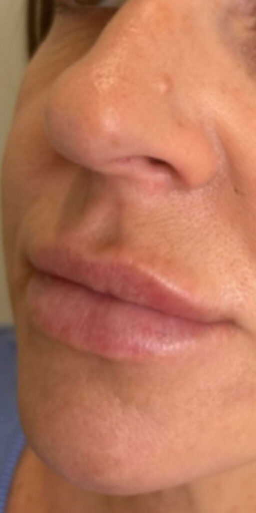 Dermal Fillers